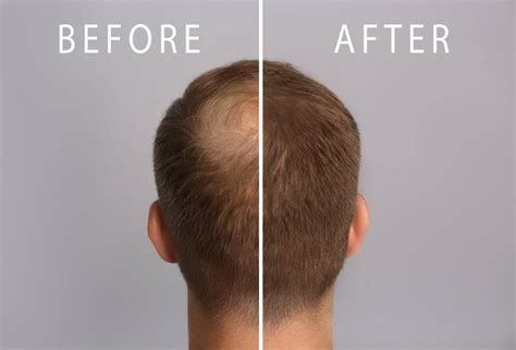Finasteride Before And After: Timeline And Results | Blog Meds For Less