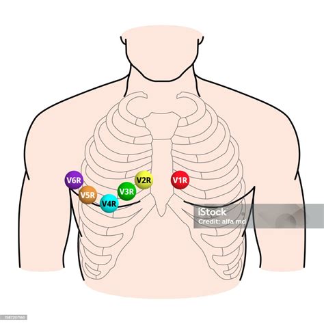 Right Sided Ecg Electrode Placement Electrocardiogram Lead V1r V2r V3r V4r V5r V6r Positions ...