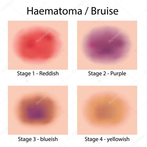 Cuerpo de ilustración con diferente hematoma, contusión. Ideal para catálogos, informativos e ...