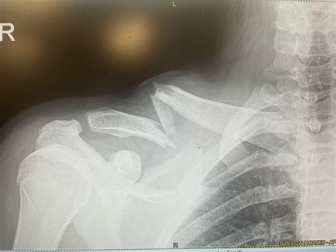 Clavicle Break