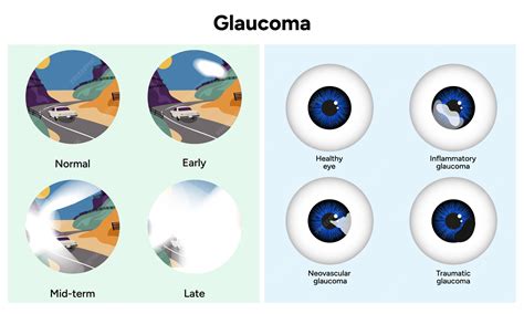 Premium Vector | Inflammatory glaucoma Neovascular glaucoma Traumatic glaucoma Early midterm and ...