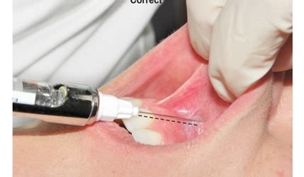 Local Anesthesia Injection 的图像结果