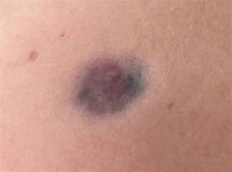 Image result for Dermatofibrosarcoma Protuberans