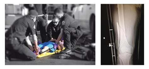 Traction Splint Comparison | Types and Uses in Femoral Traction - Rescue Essentials