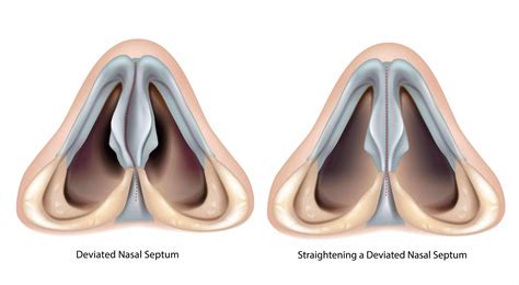 Septoplasty - Correct Nasal Blockages | Aglow ENT Centre