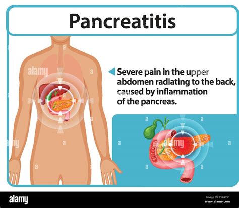 Illustration of pancreatitis symptoms and affected organs Stock Vector Image & Art - Alamy