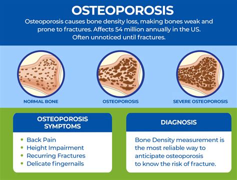 Understanding difference b/w Osteoarthritis vs Osteoporosis