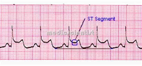 Image result for Pacemaker Programming