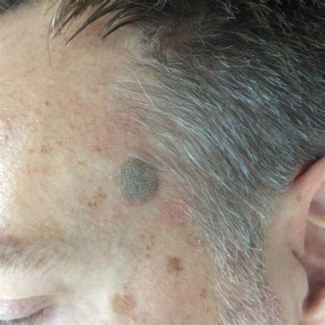 How to Get Rid of Facial Warts - Treatment and Prevention