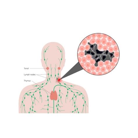 Image result for Lymphatic System Disorders