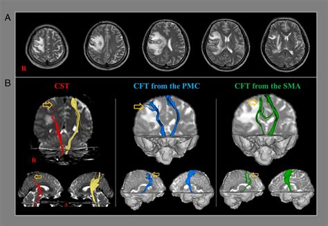 Limb-Kinetic Apraxia Due to Injury of the Corticofugal Tract ...