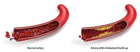 High cholesterol - symptoms, causes & levels - BHF