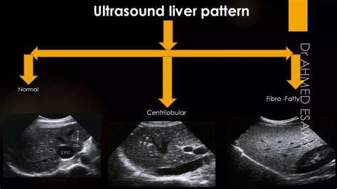Ultrasound diffuse liver disease all things fibrosis,cirrhosis,us scoring,ce lrad,fibroscan ...