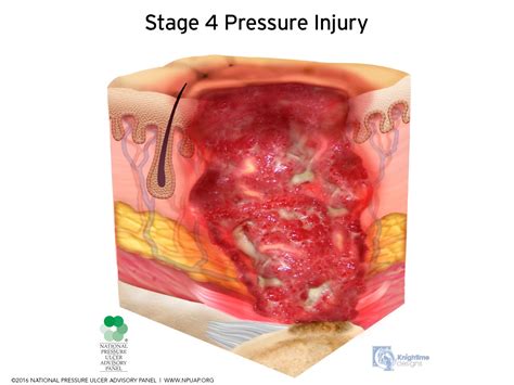 Pressure Injuries - Physiopedia