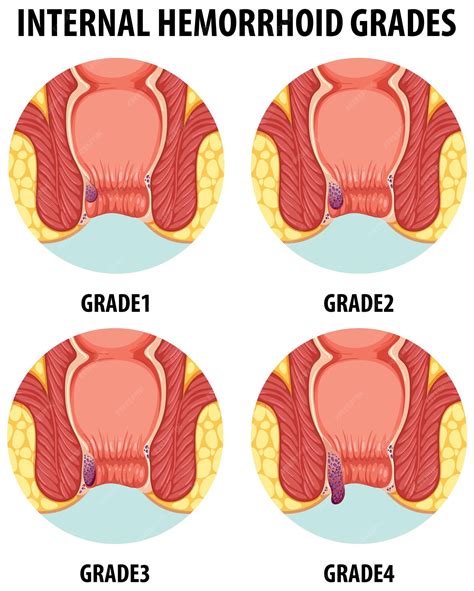 Anatomía ilustrada de las hemorroides internas humanas en diferentes ...