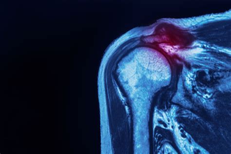 Torn Rotator Cuff – Symptoms and Treatments - , Lubbock Sports Medicine