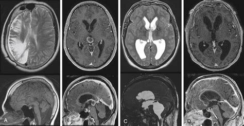 Clinical Evaluation of Hydrocephalus in Adults - Clinical Tree