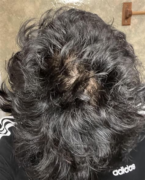 18M wavy haired with widows peak and have a fast growing hair am i balding or paranoid af? : r ...