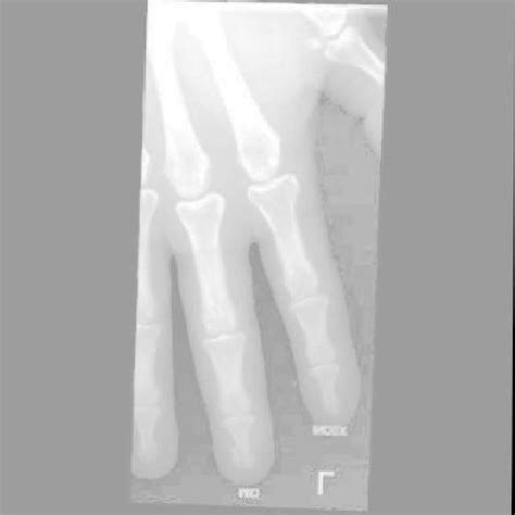 Bone Fracture Detection Using Image Processing Source Code GitHub 的图像结果