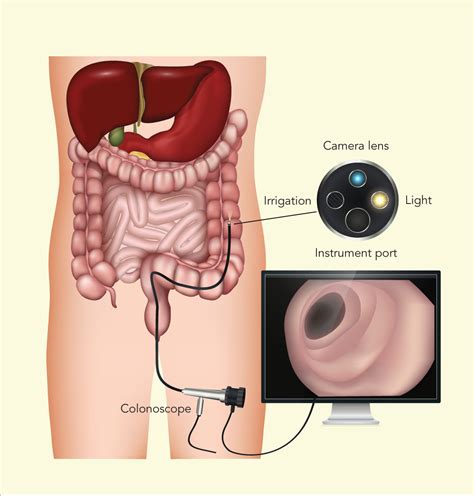 Image result for Why Colonoscopy Test Is Done