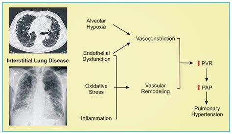 Pharmacology and Emerging Therapies for Group 3 Pulmonary Hypertension ...