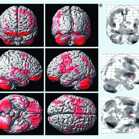 Image result for Multiple System Atrophy Progression