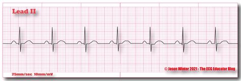 ECG Educator Blog : Normal Sinus Rhythm