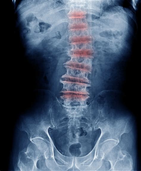 What Is Multilevel Degenerative Disc Disease? - Chiropractor Richardson TX