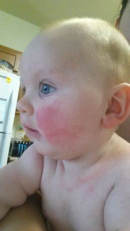 Roseola? Fifth disease? Heat rash? HELP! | BabyCenter