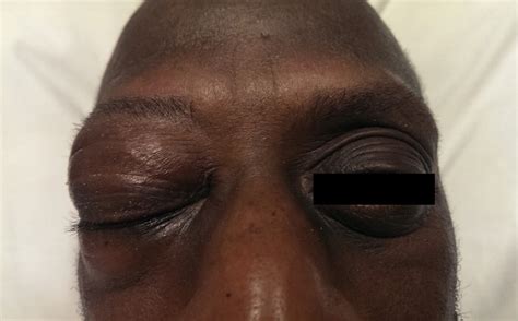 Popping My Eye Out 的图像结果