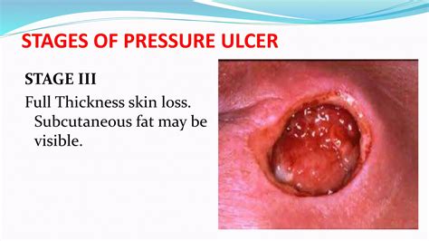 Pressure ulcer ppt | PPTX