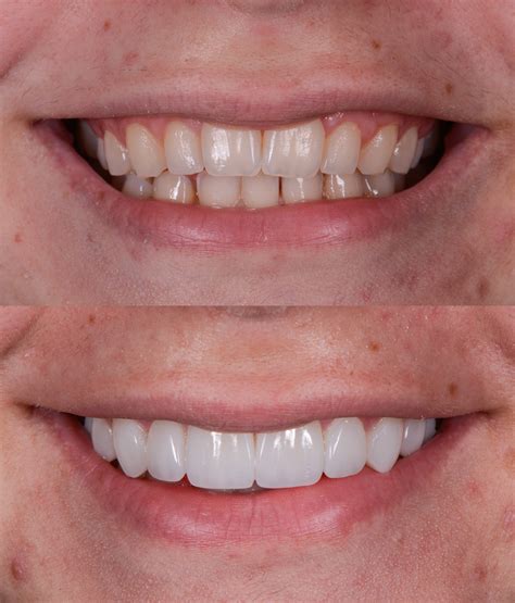 Composite Resin Veneers