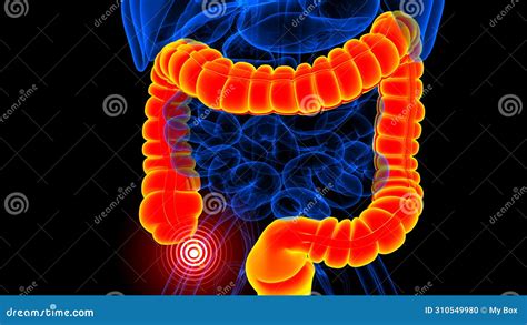 Image result for Appendix Pain Area