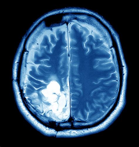 Brain Tumor Overview - Harvard Health