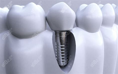 即刻负重种植牙技术成熟吗？了解即刻负重种植牙原理后觉得靠谱_皓齿口腔网