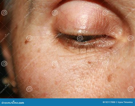 Pigmentation on the Face. Brown Spot Stock Photo - Image of medicine ...