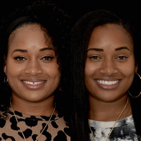 Gallery: Before and After Dental Veneers in Los Angeles, CA | Smiles By Dr. P