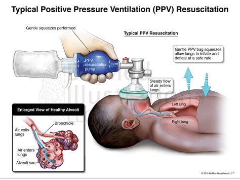 Positive Pressure Ventilation Illustration by BioMed Illustrations LLC ...