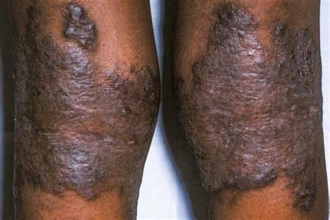 why doctor's struggle to identity eczema on darker tones Background