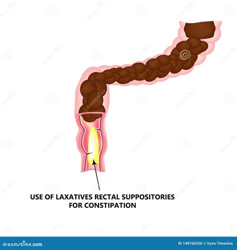 Use of Laxatives Rectal Suppositories for Constipation. Feces in Colon. Infographics Stock ...