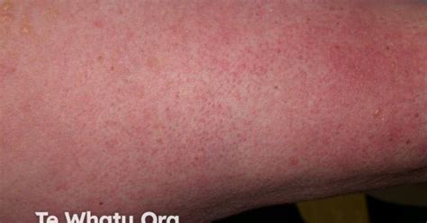 Rash Pictures SJS 的图像结果