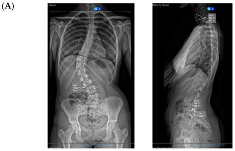 Posterior Vertebral Pedicular Tethering for the Treatment of Idiopathic ...
