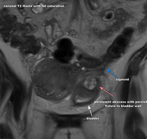 Complicated diverticulitis with colovesical fistula and b...