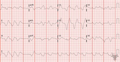 Hyperkalemia | ECG Stampede