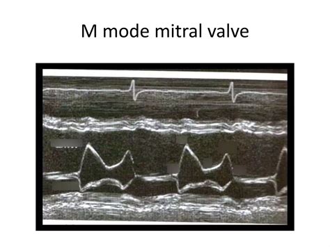 Mitral stenosis Echocardiography | PPT