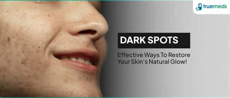 Elocon Cream: Uses, Side Effects, Price & Substitutes