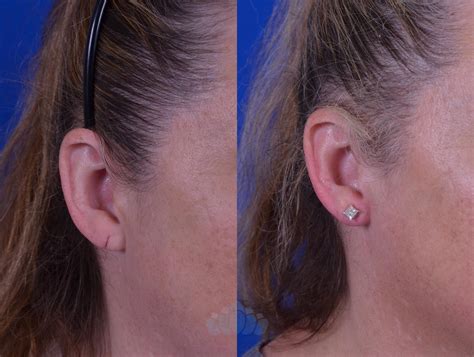 Earlobe Repair Before and After Pictures Case 9 | Charlotte, NC | Dilworth Facial Plastic Surgery