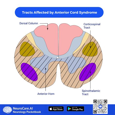 Anterior Cord Syndrome