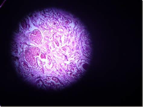 Histology Slides Database: Cavernous Hemangioma histopathology