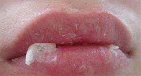 孩子嘴唇经常干燥起皮？注意了，4个原因起码中一个！_平安健康